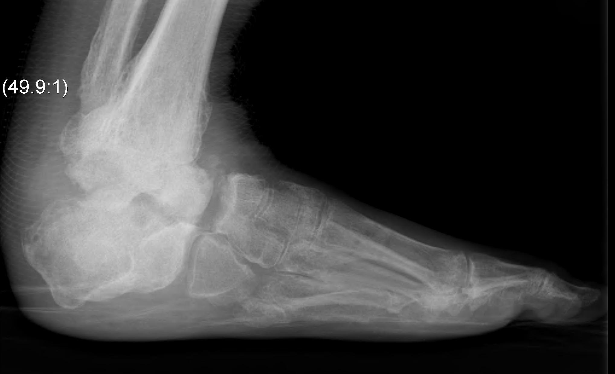 Charcot Hindfoot